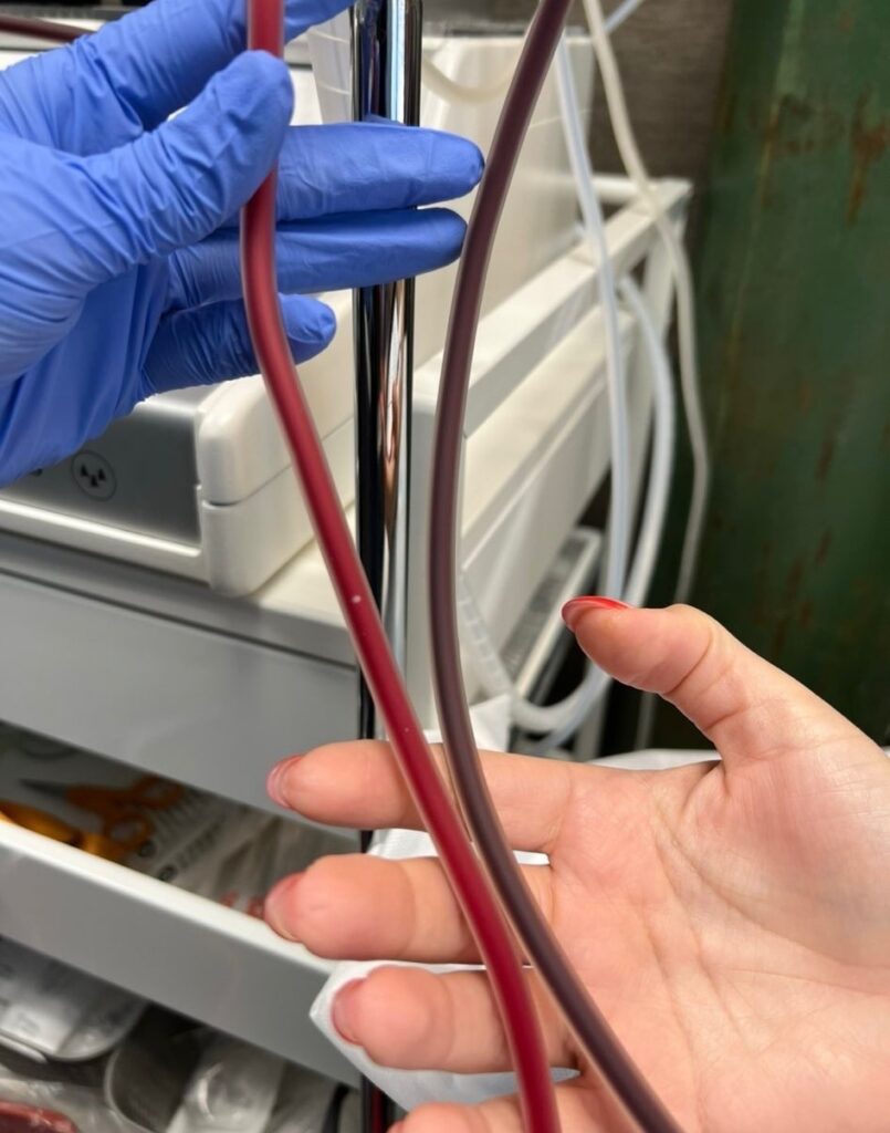 Blood draw and tubing during EBOO therapy process, supporting cellular health and detoxification.